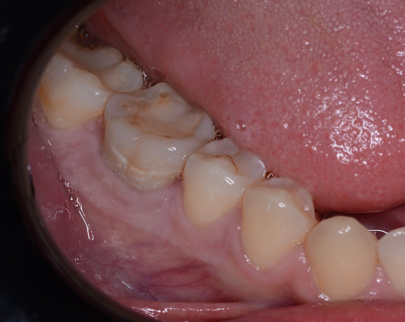 Corona unitaria en sector posterior — Pieza 46 — Antes