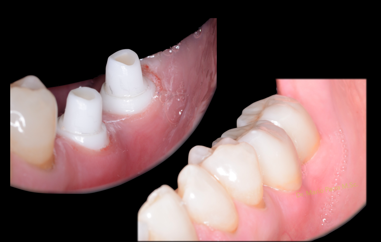 Coronas de zirconio sobre implantes región 36-37 antes y después · fotografía intraoral clínica