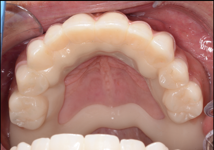 Prótesis telescópica — Zirconio y PEEK — Vista oclusal en boca