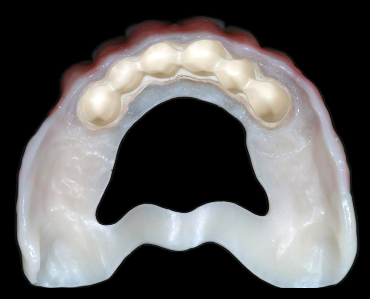 Prótesis telescópica — Zirconio y PEEK — Cara tisular