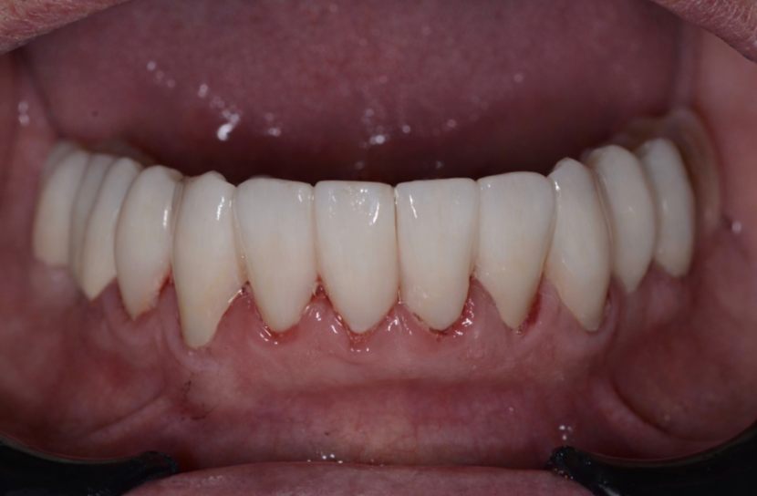 Arcada inferior completa — Después