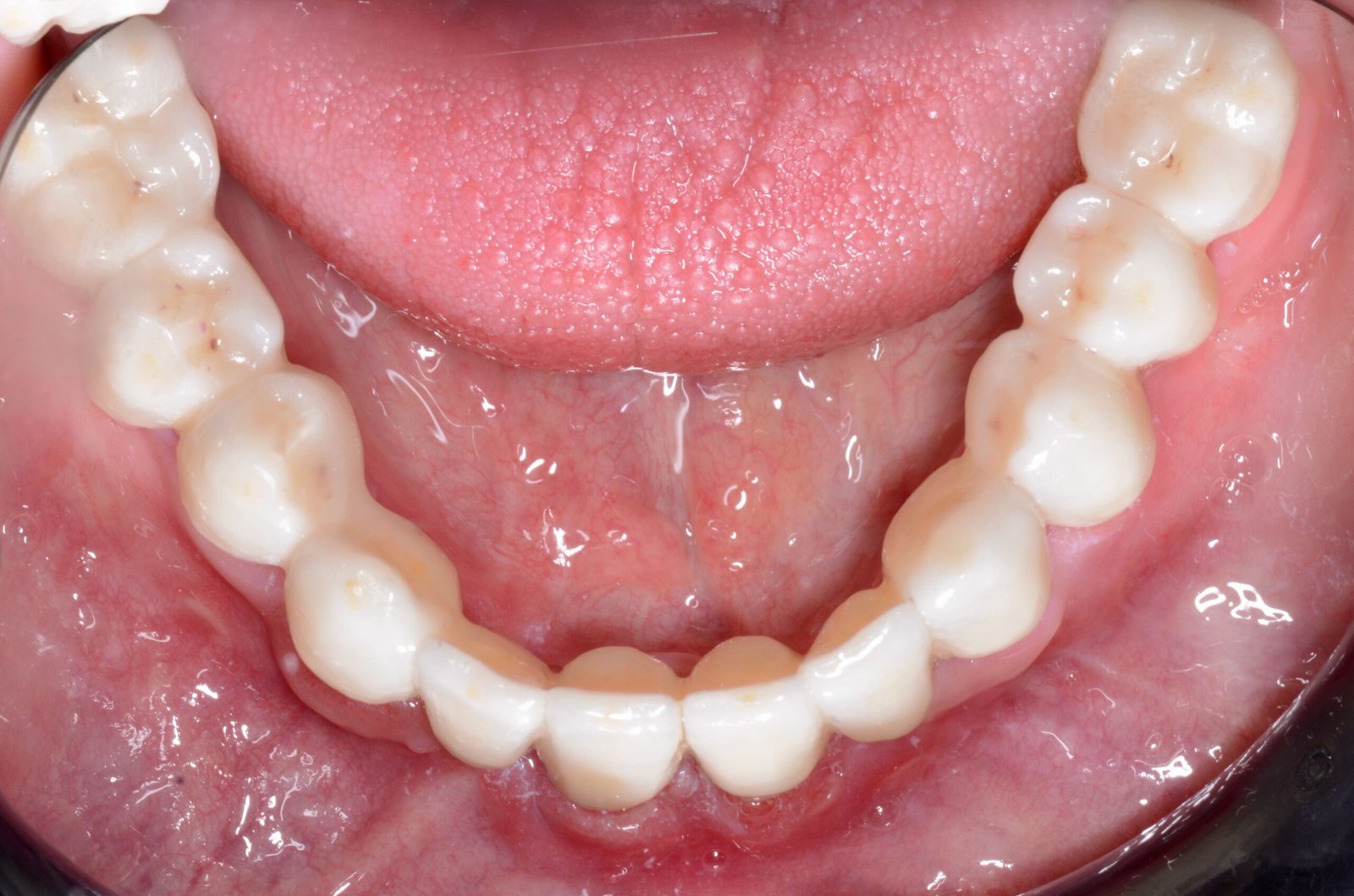 Arcada superior e inferior completa sobre 8 implantes — Maxilar inferior