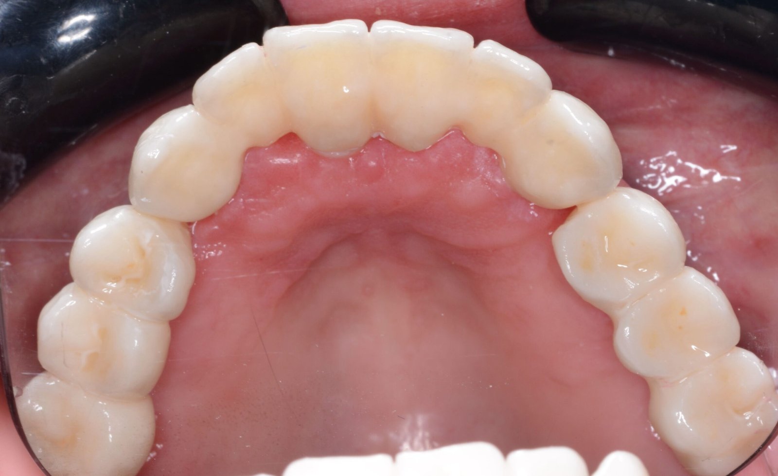 Arcada superior e inferior completa sobre 8 implantes — Maxilar superior
