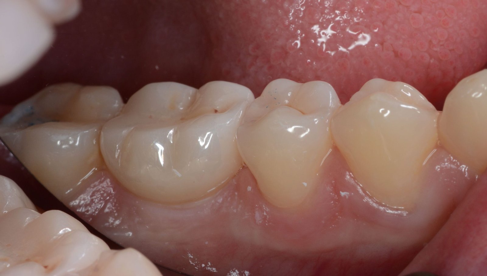 Corona de zirconio en boca · pieza 46 · Biohealth Dental Lab