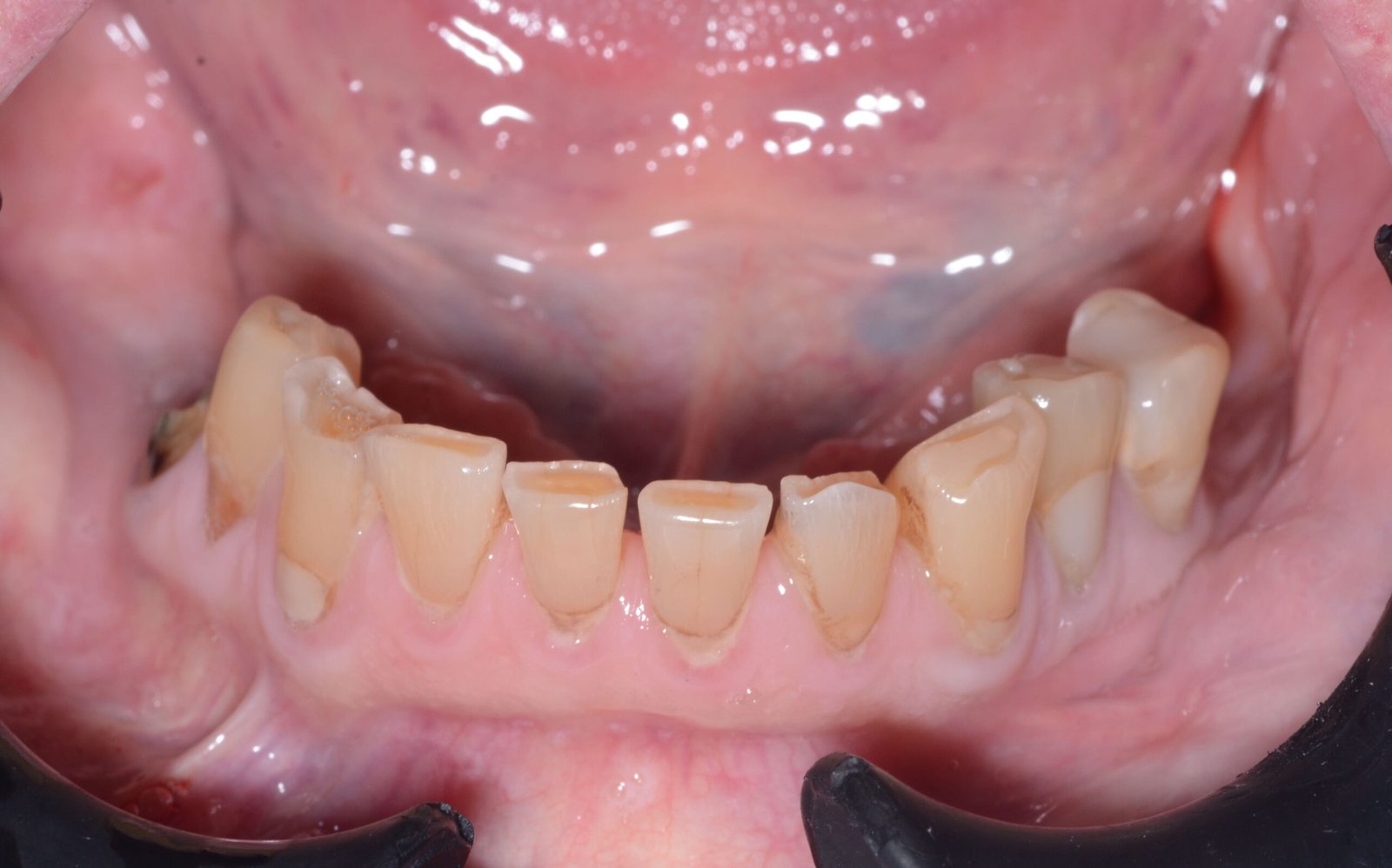 Arcada inferior completa — Antes