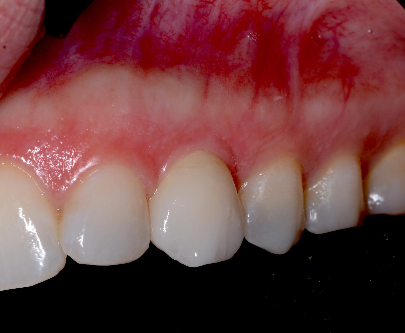 Corona unitaria en zona estética — Pieza 23 — Vista lateral