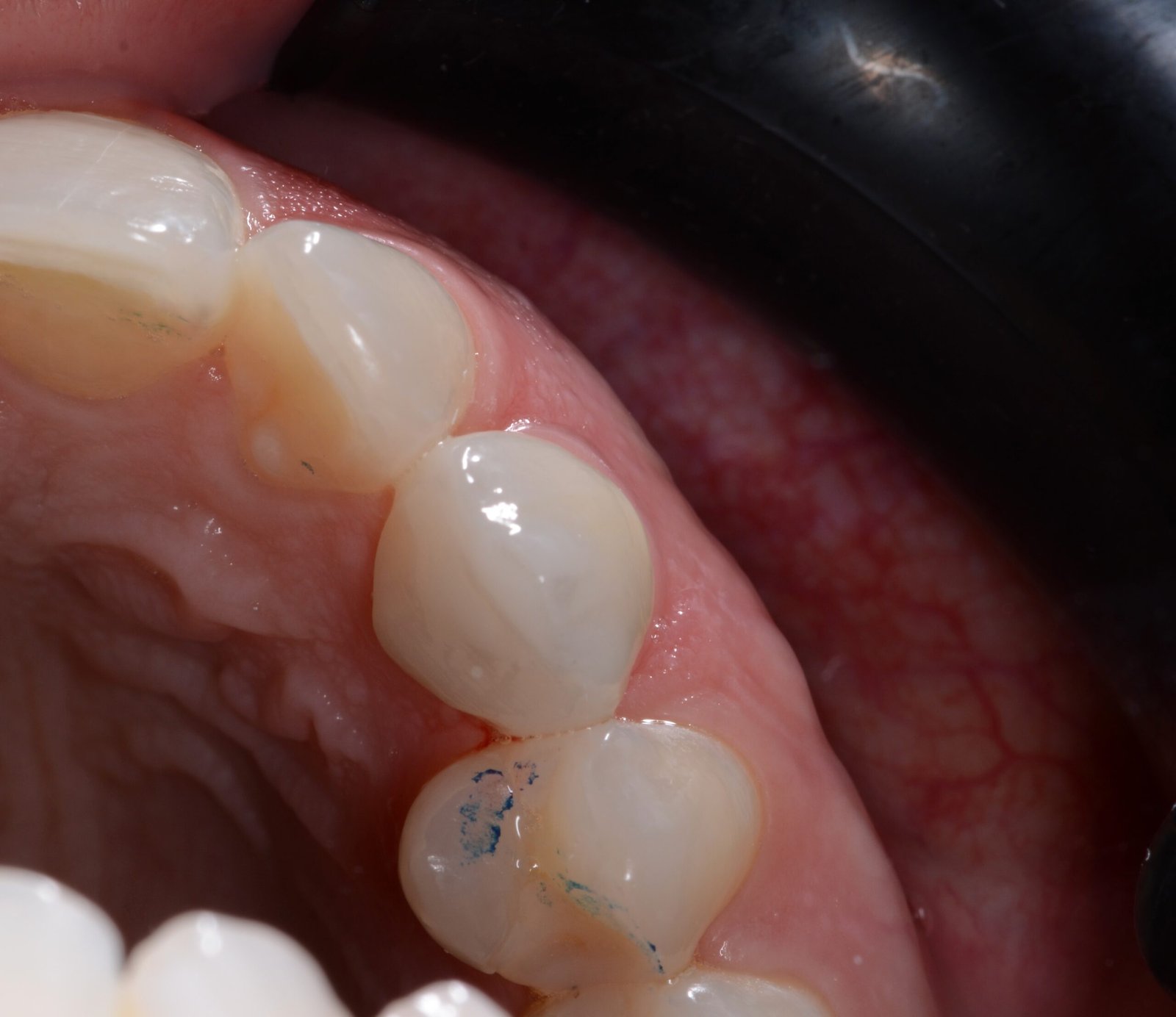 Corona unitaria en zona estética — Pieza 23 — Vista oclusal