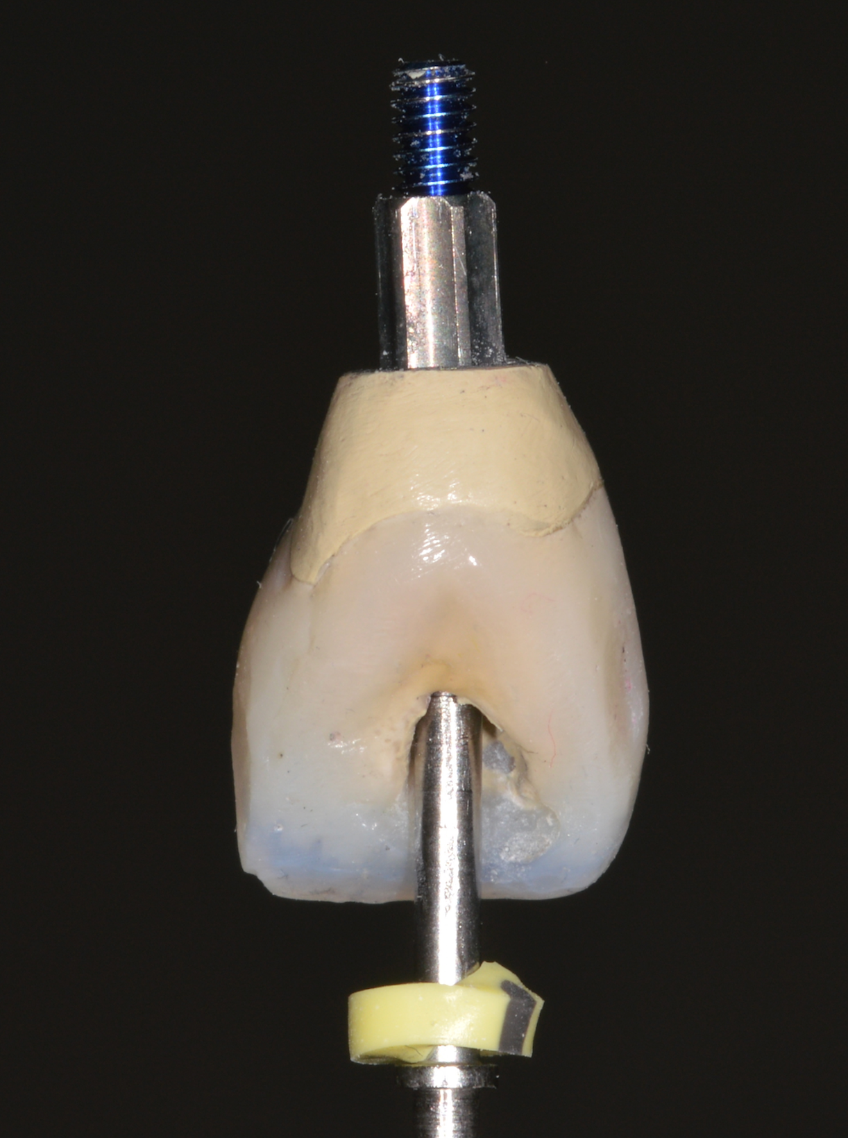 Corona individual atornillada sobre implante — Pieza 1.1 — Visión palatina