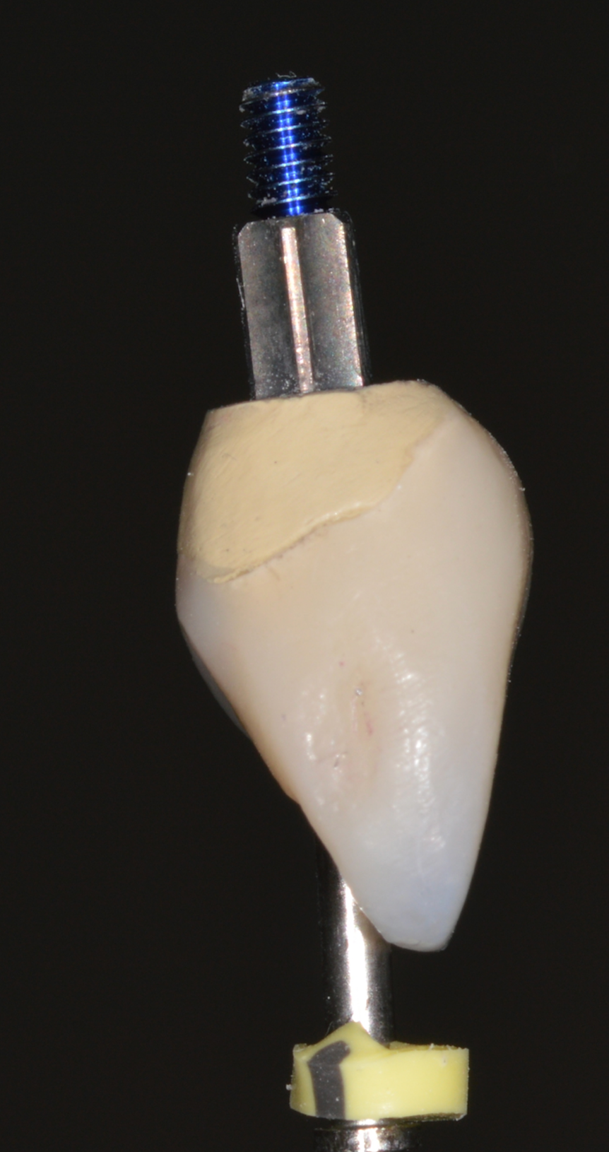 Corona individual atornillada sobre implante — Pieza 1.1 — Visión lateral