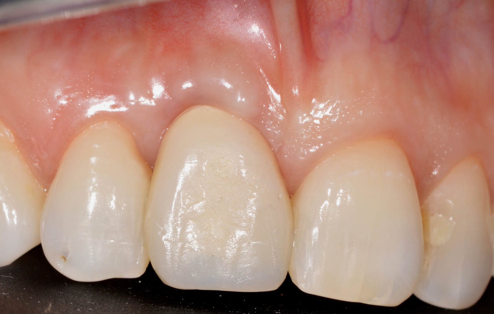 Corona individual atornillada sobre implante — Pieza 1.1 — Revisión a 12 meses