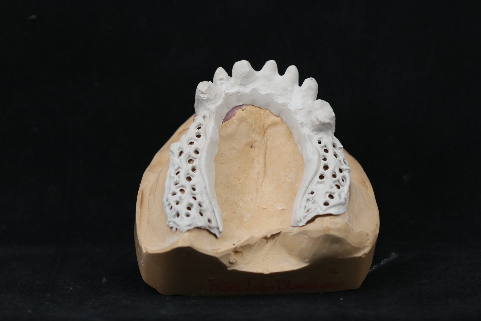 Sobredentadura telescópica en PEEK — Maxilar superior sobre 3 implantes — Estructura PEEK