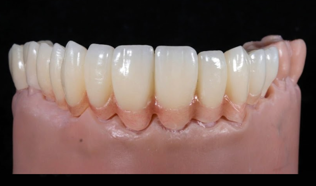 Rehabilitación de zirconio maxilar superior con 12 coronas en Biohealth Dental Lab