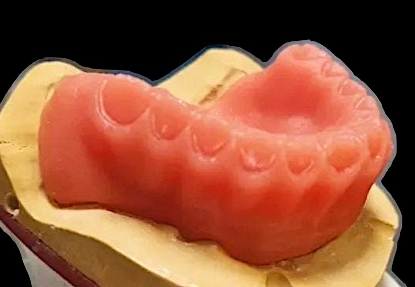 Estructura de prótesis removible impresa en resina 3D en Biohealth Dental Lab