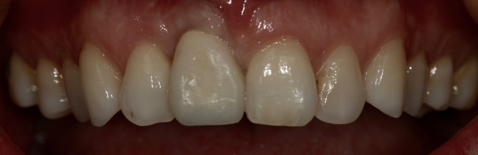 Corona individual atornillada sobre implante — Pieza 1.1 — Resultado final