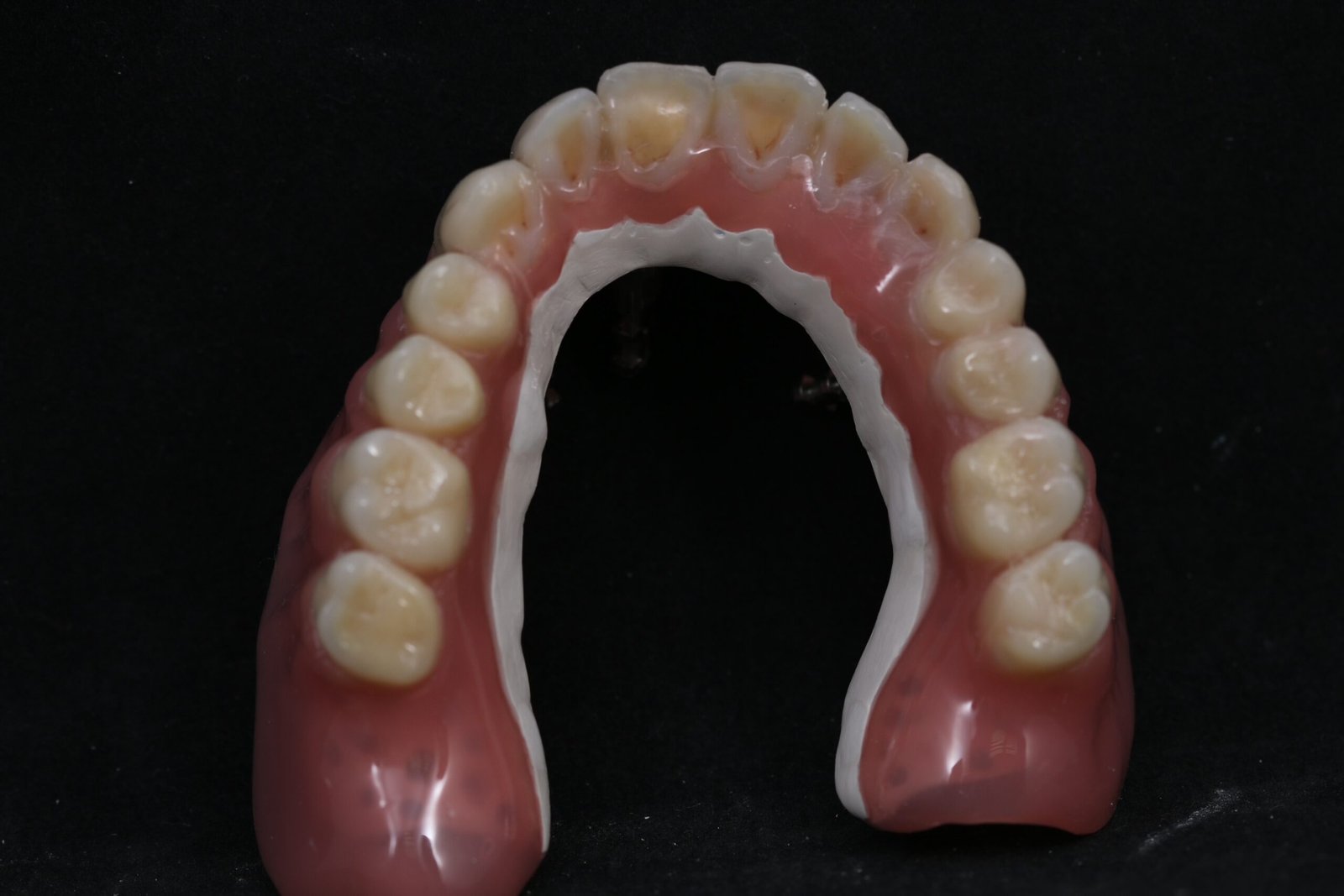 Sobredentadura telescópica en PEEK — Maxilar superior sobre 3 implantes — Vista oclusal