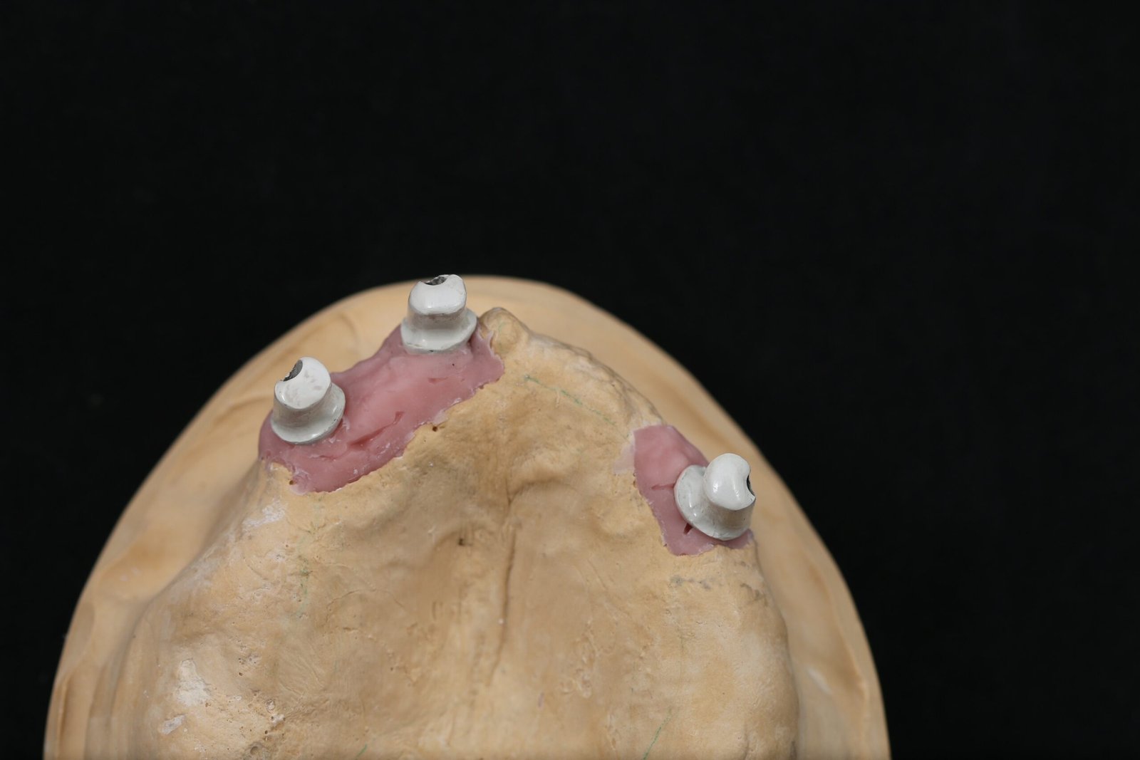 Sobredentadura telescópica en PEEK — Maxilar superior sobre 3 implantes — Telescópicas en modelo
