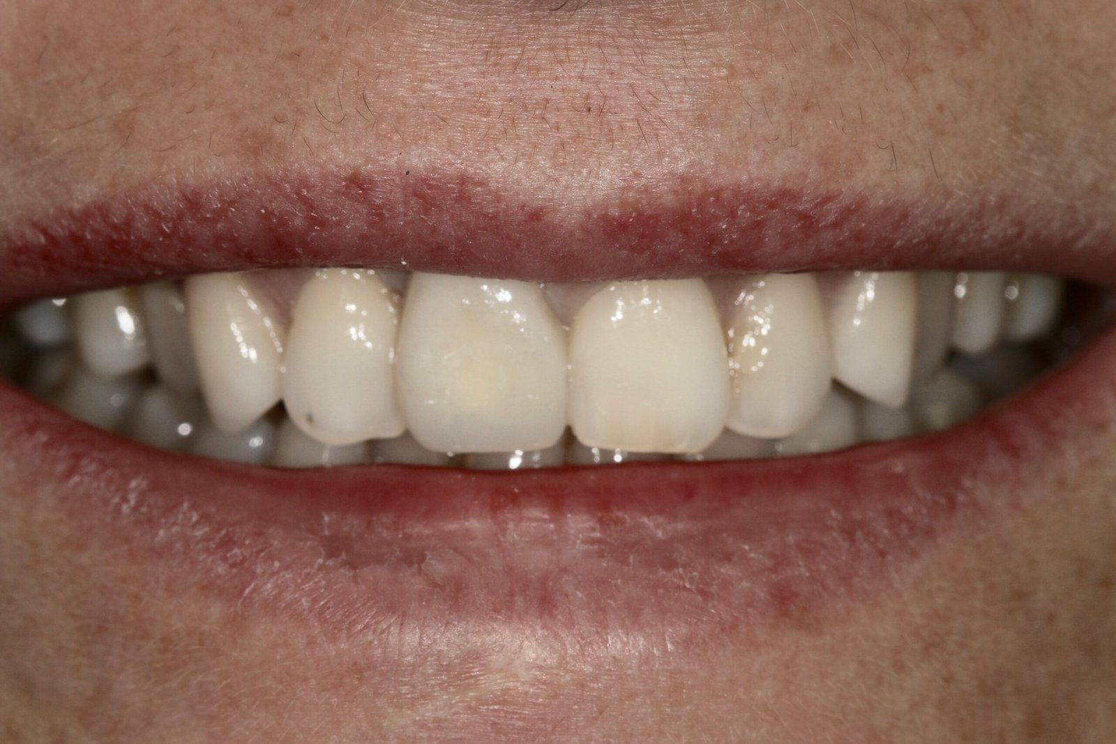 Corona individual atornillada sobre implante — Pieza 1.1 — Sonrisa