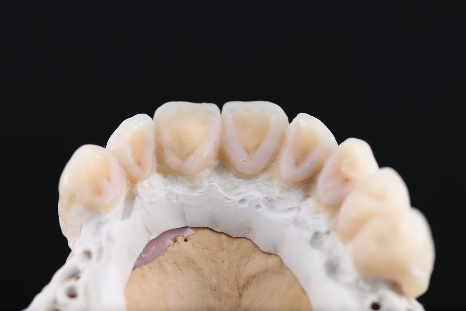 Sobredentadura telescópica en PEEK — Maxilar superior sobre 3 implantes — Detalle palatino