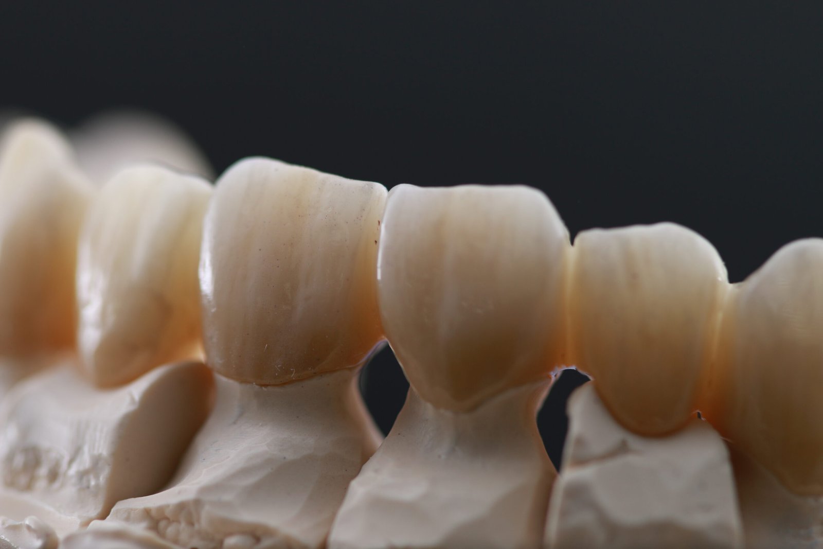 Puente de zirconio en sector estético — Textura y detalle natural — Vista frontal en modelo