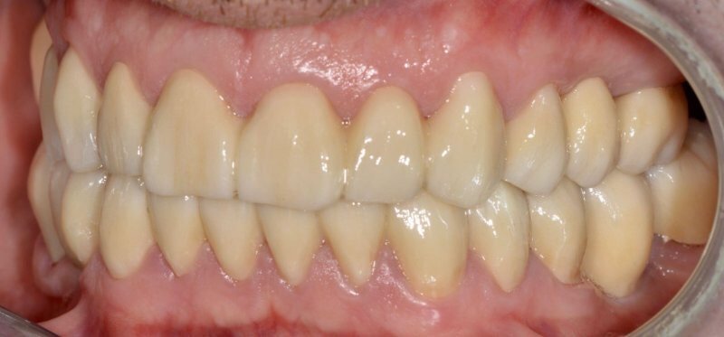 Rehabilitación completa en zirconio — 10 años en boca — Vista lateral