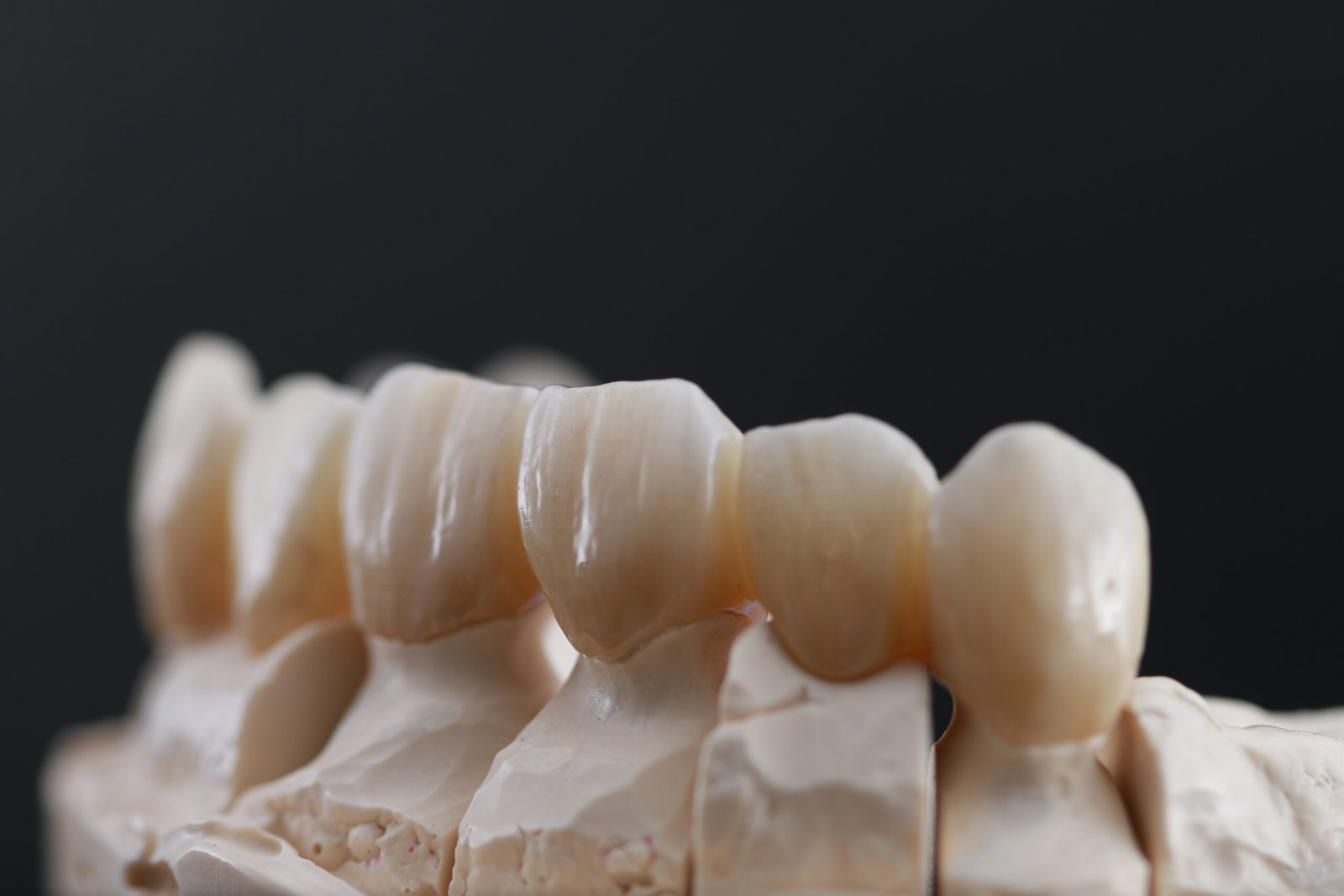 Puente de zirconio en sector estético — Textura y detalle natural — Detalle de textura