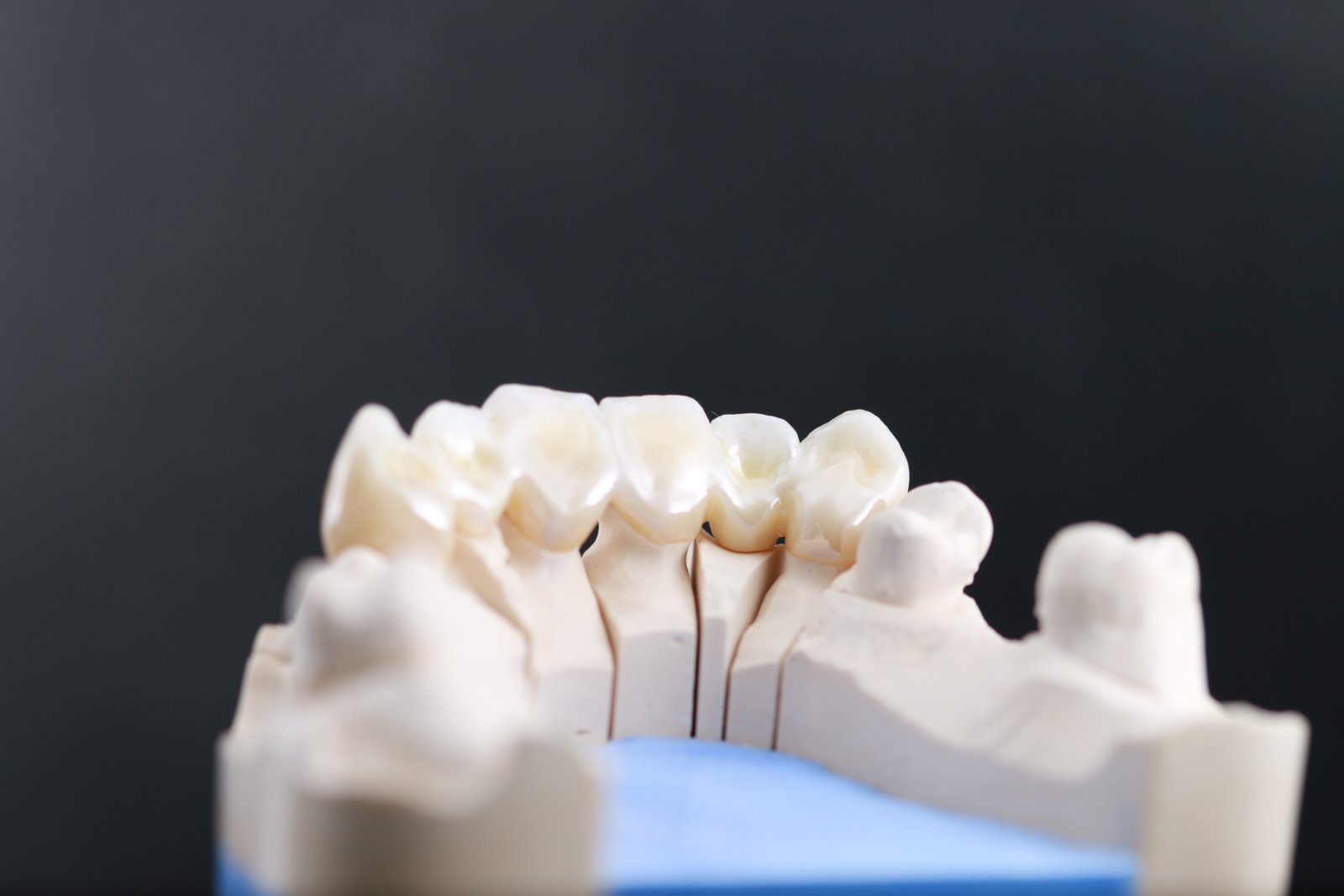 Puente de zirconio en sector estético — Textura y detalle natural — Vista palatina